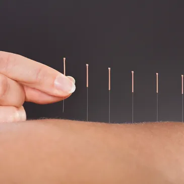 Dry Needling Therapy Calgary